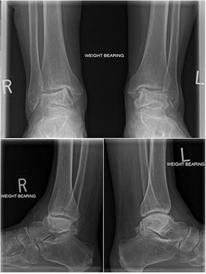 Development and Implantation of a Universal Talar Prosthesis